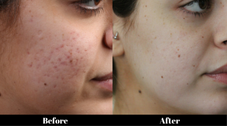Skin Needling Melbourne for acne scarring treatment