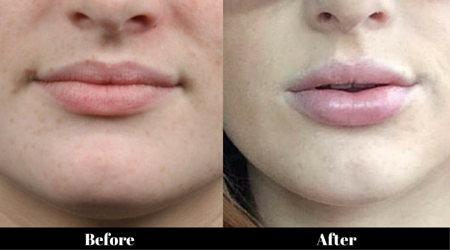 What Causes Swollen Lips? - Verywell