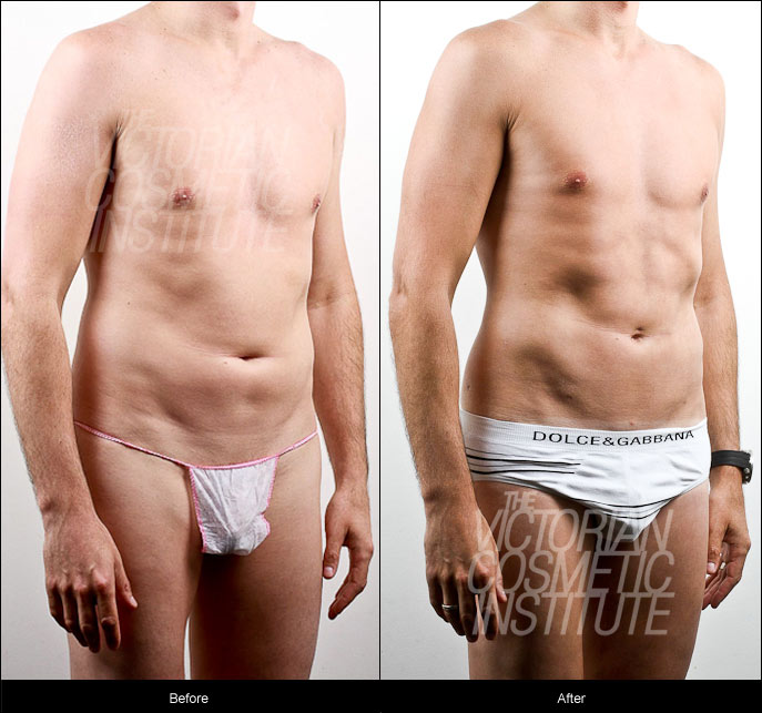 Liposuction to male abdomen and hips before and after
