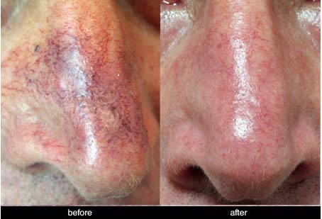 capillaries on nose before and after