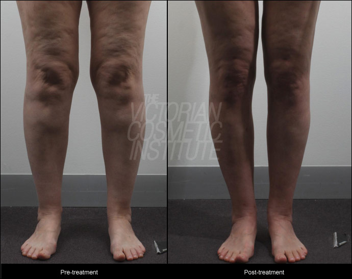 Liposuction to calves and ankles before and after
