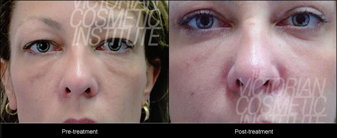 Eyelid Surgery Blepharoplasty treatment before and after close up photo
