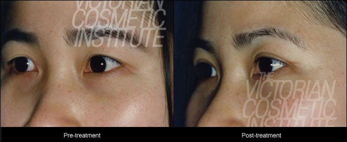 blepharoplsty before and after close up photo case study 2