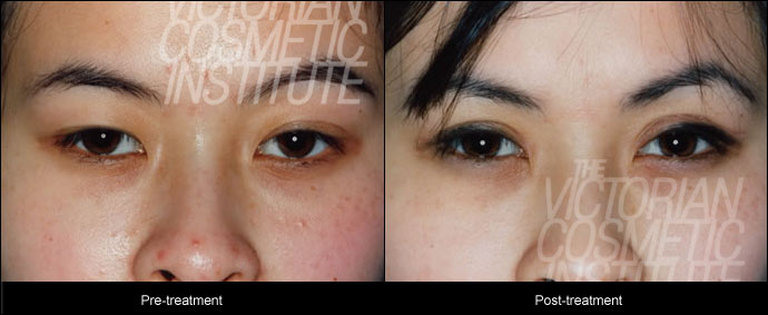 blepharoplsty treatment before and after close up case study 5