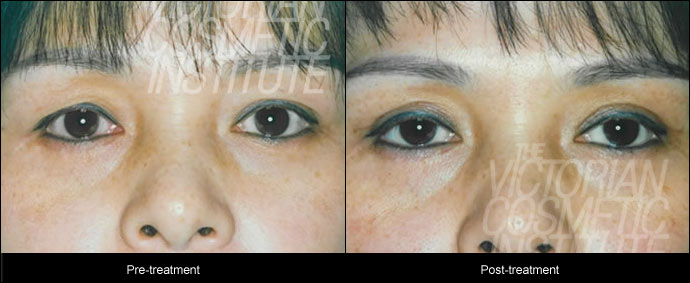 blepharoplsty treatment before and after close up case study 7