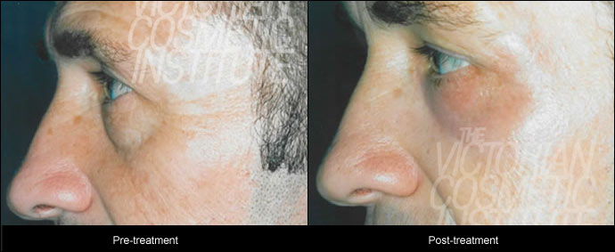 blepharoplsty treatment before and after side case study 8