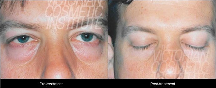 blepharoplsty treatment before and after close up case study 9