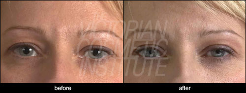 botox melbourne before and after 