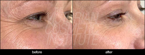Anti-Wrinkle Injections crow feet before and after case study 5