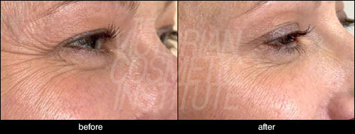 anti-wrinkle case study photo