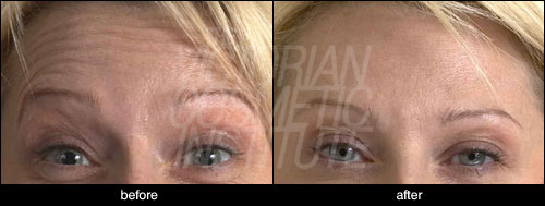 Anti-Wrinkle Injections crow feet eyes open before and after case study 5