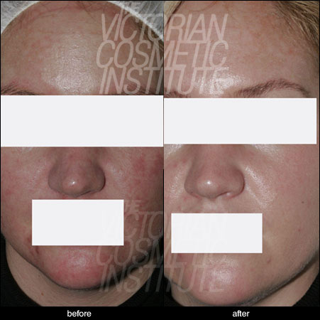 Chemical Peels Case Study