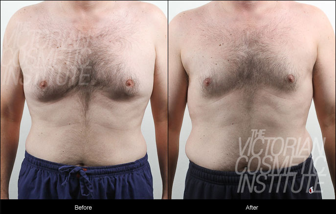 Gynaecomastia (man boobs) Before and After Case Study 2 Front