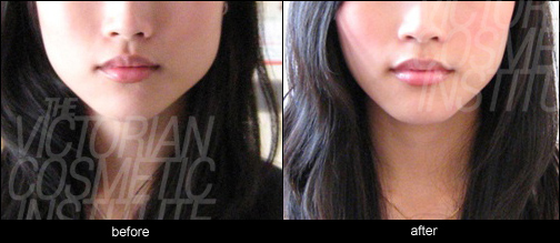 botox Melbourne masseter muscle before and after case study 6