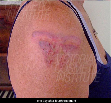 One day after fourth treatment