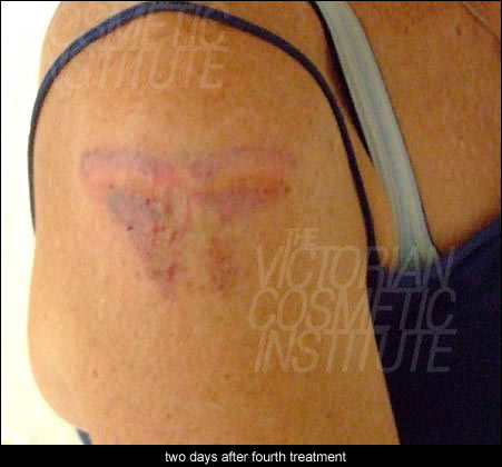 two days after fourth treatment
