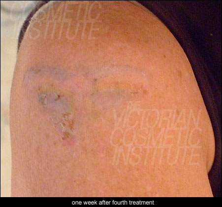 one week after fourth treatment