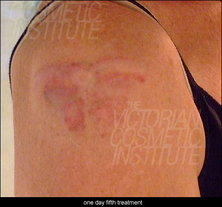 one day after fifth treatment