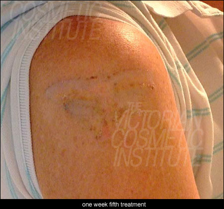 one week after fifth treatment