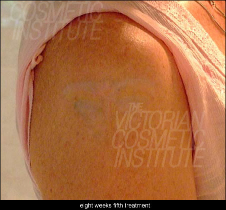 eight weeks after fifth treatment