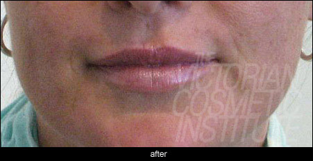 Lip fillers melbourne after photo