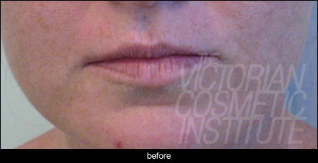 lip fillers melbourne before photo
