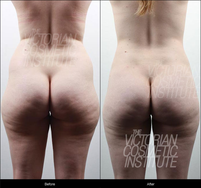 Liposuction Case Study 1 : abdomen, hips, inner and outer thighs - Back