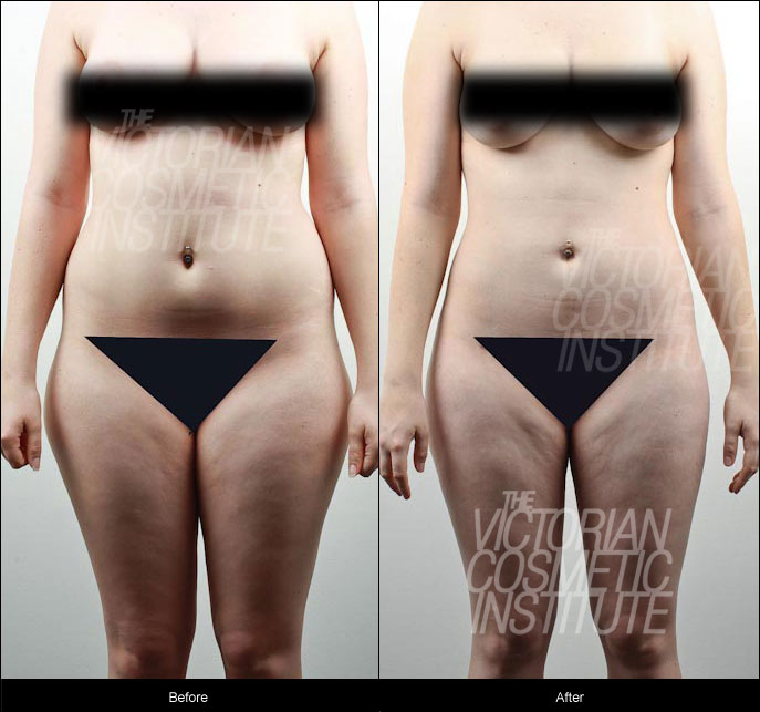 Liposuction case study 1 - abdomen, hips, inner and outer thighs. Front.