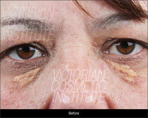 xanthelasma before image