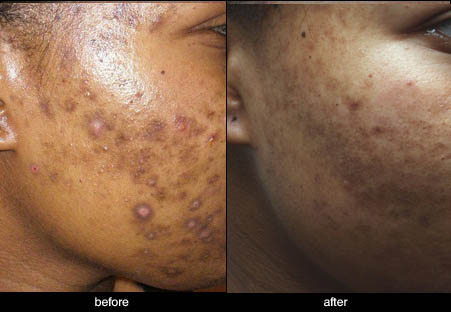 ruby laser treatment for Post-inflammatory hyperpigmentation before and after