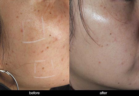 vascular laser treatment asian pigmentation before and after