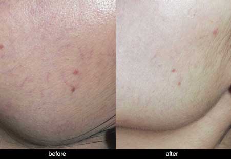 facial veins before and after treatment