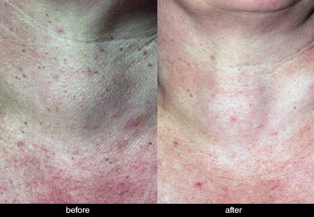 dermatosis papulosa nigra on neck before and after