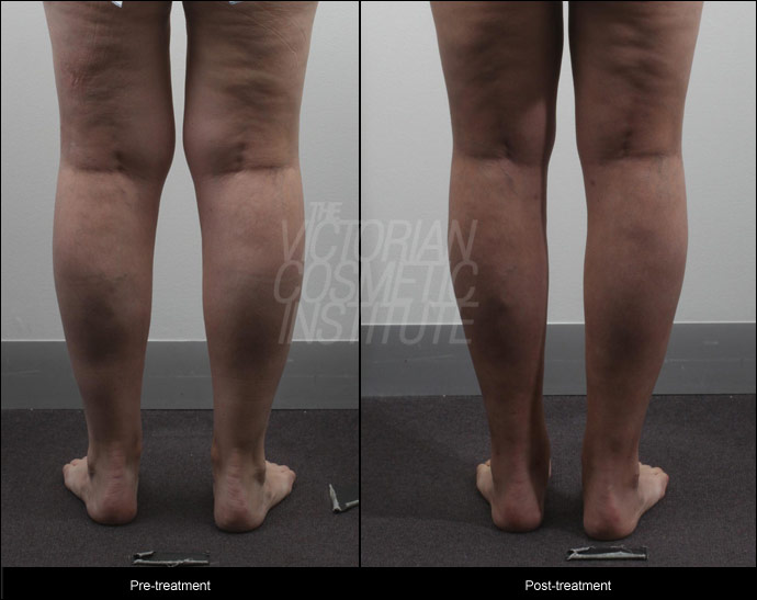 Liposuction to calves and ankles before and after view from back