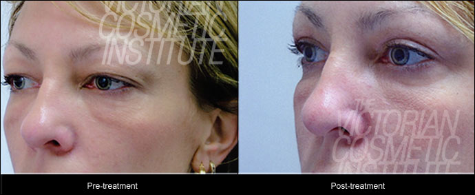 blepharoplsty before and after treatment side case study 1