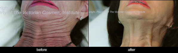 Anti-Wrinkle Injections platysmal band before and after case study 3