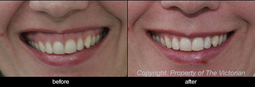Anti-Wrinkle Injections upper lip before and after case study 4
