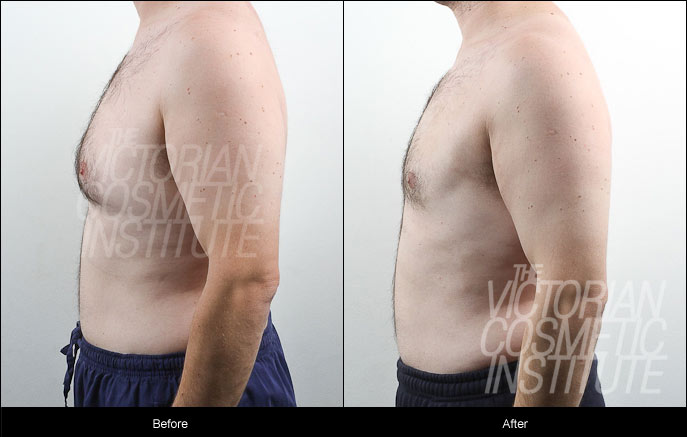 Gynaecomastia (man boobs) Before and After Case Study 2