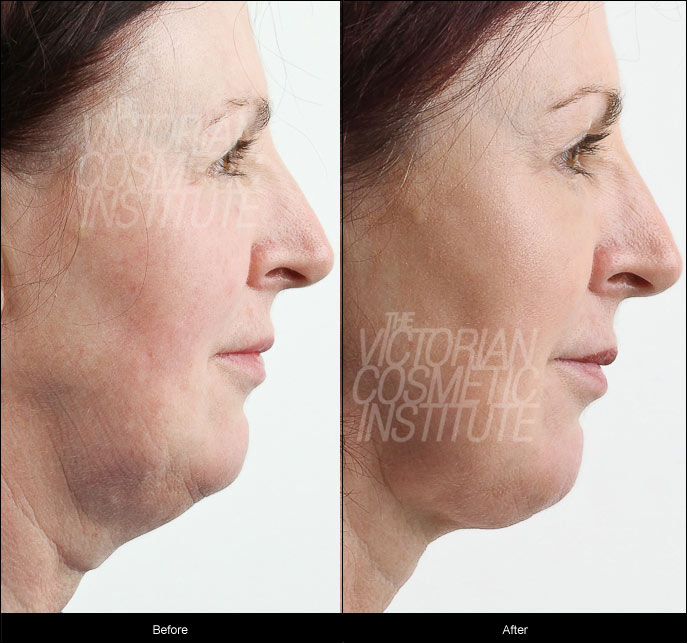 liposuction neck and jowls before and after