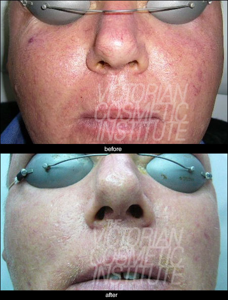 facial redness and capillaries before and after