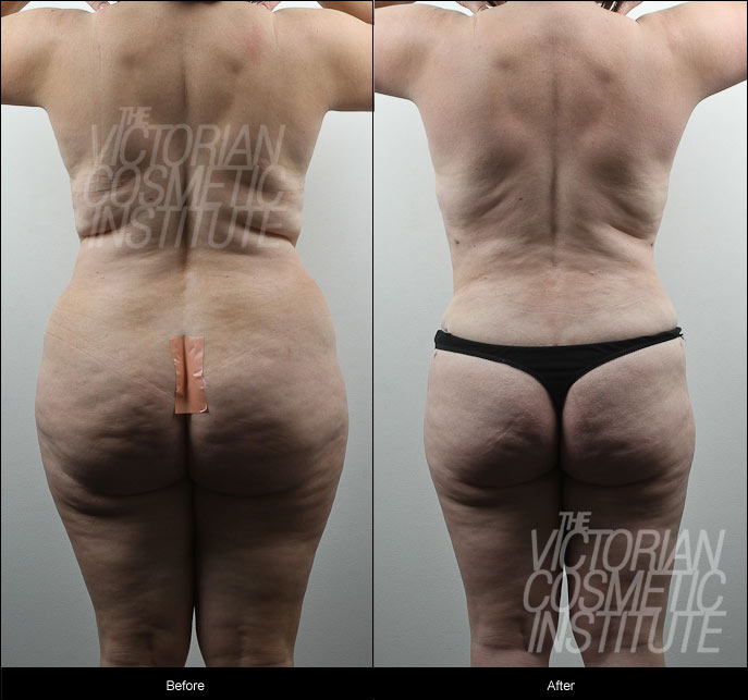 liposuction to the buttocks, hips, waist, and outer thighs before and after