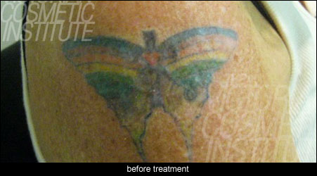 laser tatoo removal before treatment