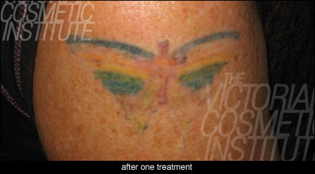 laser tatoo removal after one treatment