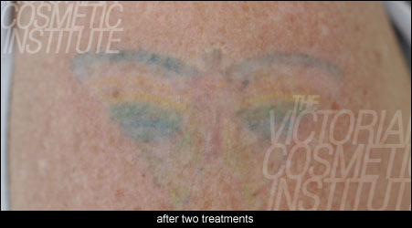 laser tatoo removal after two treatments