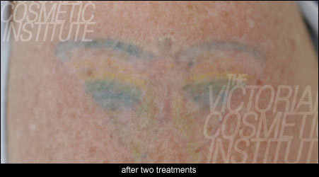 Laser Tattoo Removal Patient Diary – Part One - Victorian Cosmetic Institute Laser Tattoo Removal Patient Diary – Part One - Victorian Cosmetic Institute