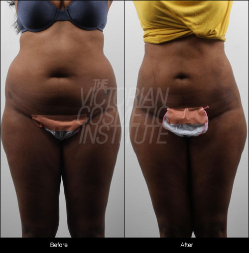 liposuction and fat transfer to buttocks before and after