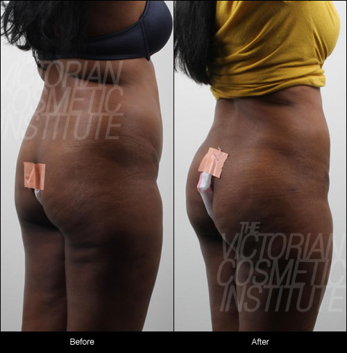 liposuction and fat transfer to buttocks before and after view from back