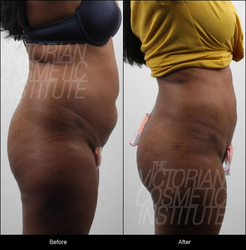 liposuction and fat transfer to buttocks before and after view from side