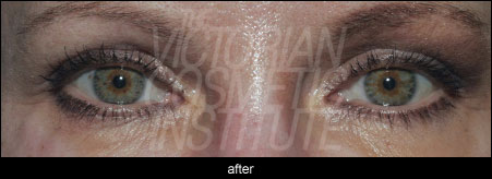 Eyebrow lift after, botox dysport, juvederm, voluma, modelis