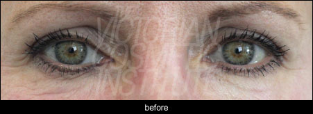 Eyebrow lift before, botox dysport, juvederm, voluma, modelis